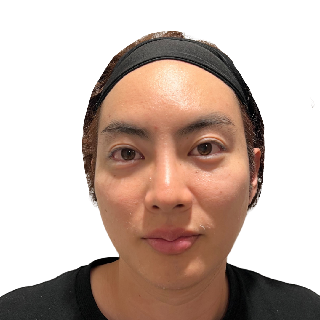 マヌカフェイシャル（ダーマペン4）